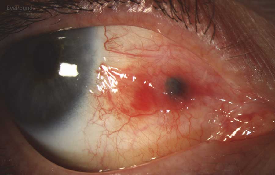 Slit lamp photograph demonstrating recurrence of amelanotic melanoma with underlying scleral degeneration