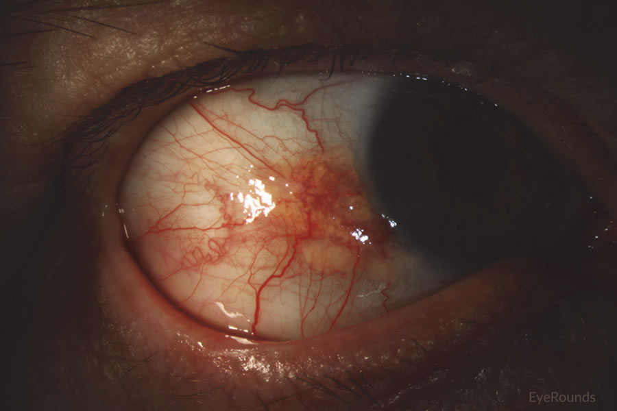 Slit lamp photo displaying conjunctival squamous cell carcinoma in situ