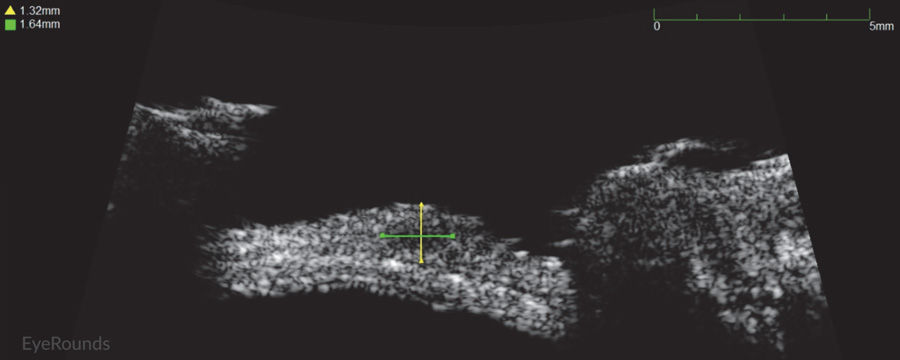 High-frequency anterior segment ultrasound displaying elevation of conjunctival lesion without extension into sclera