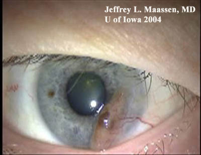 slit lamp showing conjunctival melanoma after resection