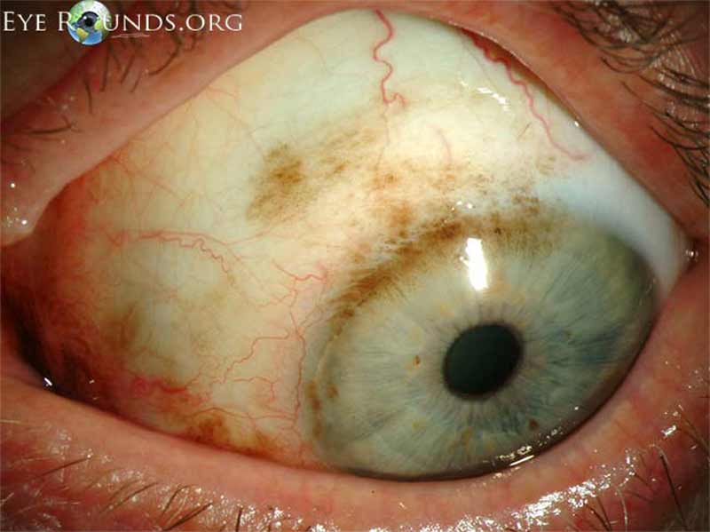 Slit lamp photo displaying primary acquired melanosis