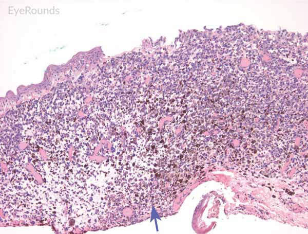 Invasive conjunctival melanoma - Hematoxylin and eosin stain displaying malignant melanoma invading the underlying substantia propria