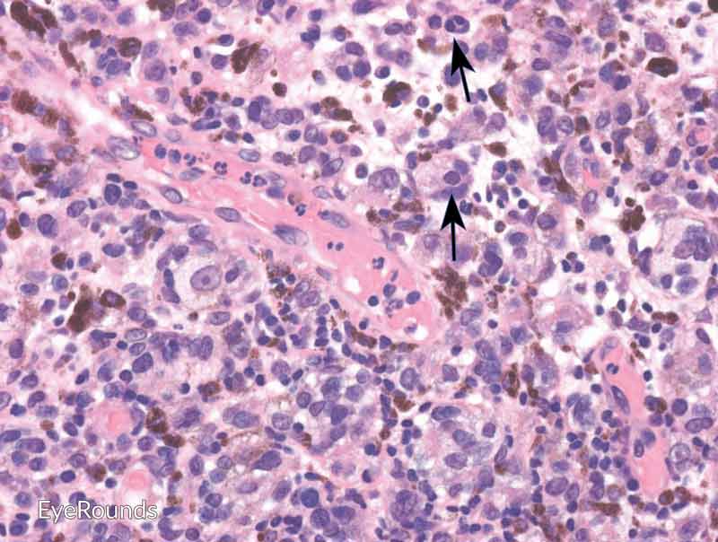 Invasive conjunctival melanoma - cytologically, the cells are notable for dysplastic features and prominent nucleoli with irregular shape and chromatin