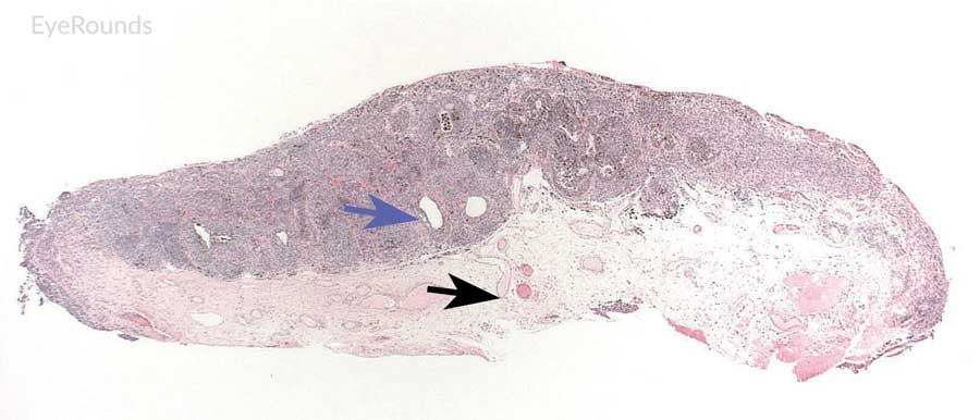 Hematoxylin and eosin stain displaying conjunctival nevus
