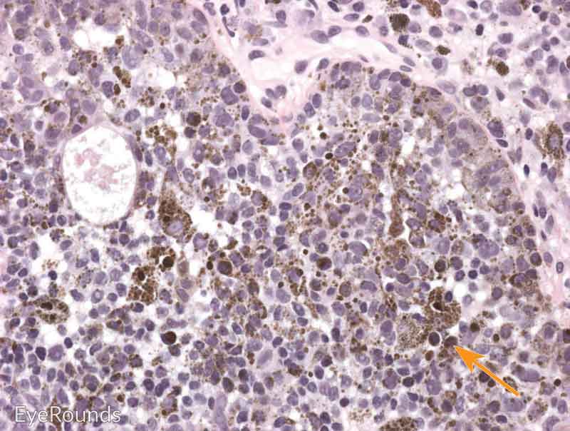 Hematoxylin and eosin stain displaying conjunctival nevus