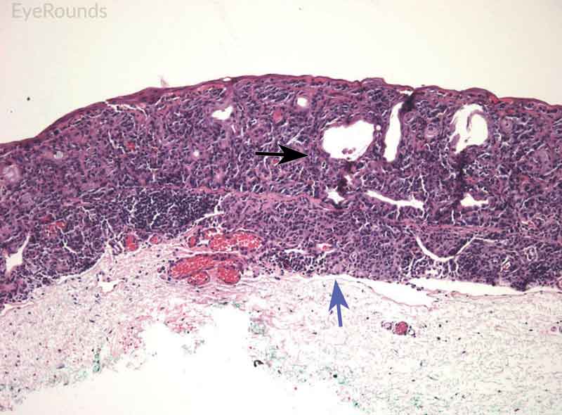 Hematoxylin and eosin stain displaying conjunctival nevus from young patient at the border of the basal epithelial layer and underlying substantia propria