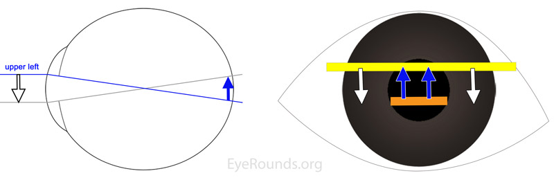 Figure 4: Left: Diagrammatic cross-section of a myopic eye, with rays of light entering the eye from the left and focusing anterior to the retina. The light that strikes the superior cornea is directed toward the inferior retina and the light that strikes the inferior cornea is directed toward the superior retina. Right: The light reflex visible in the pupil (illustrated by the orange bar) will move "against" the direction of the streak of light (illustrated by the yellow bar) from the retinoscope. Thus, as the streak moves downward, the pupillary reflex moves upward.
