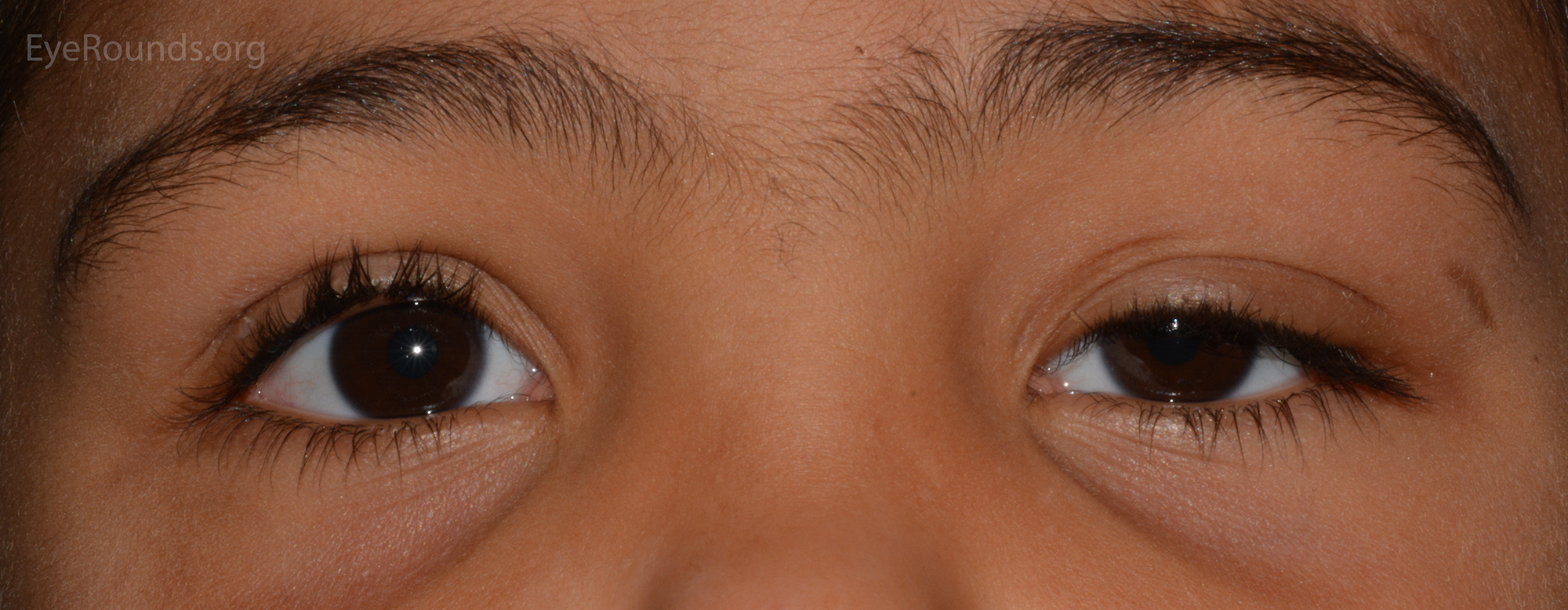 Pseudoptosis in left eye of a child with monocular elevation deficiency
