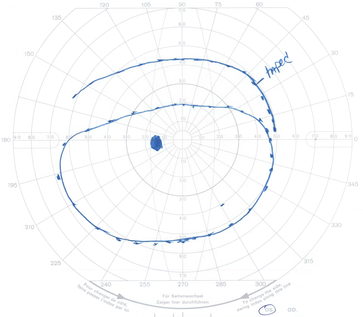 Ptosis visual field showing extent of the visual field in a patient with visually-significant ptosis before and after lifting the upper eyelid with tape