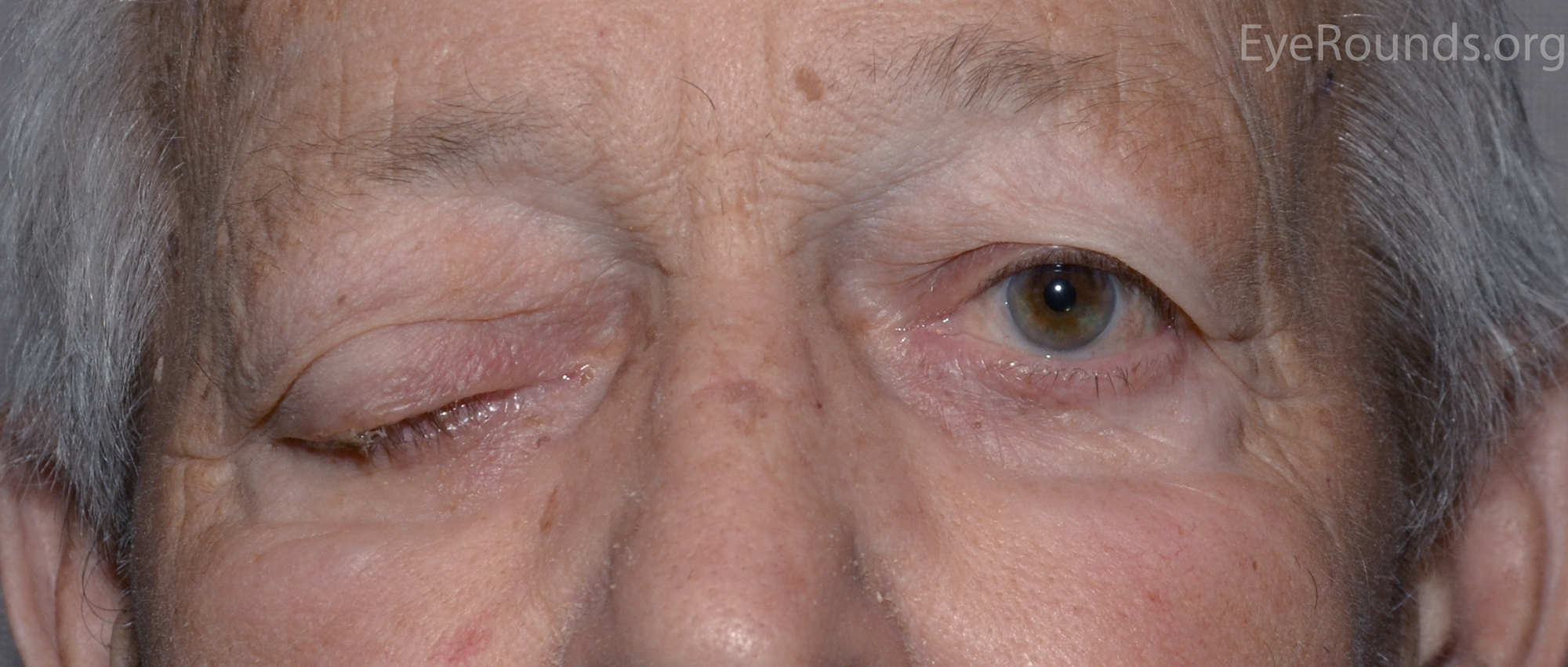 Complete right-sided ptosis 
