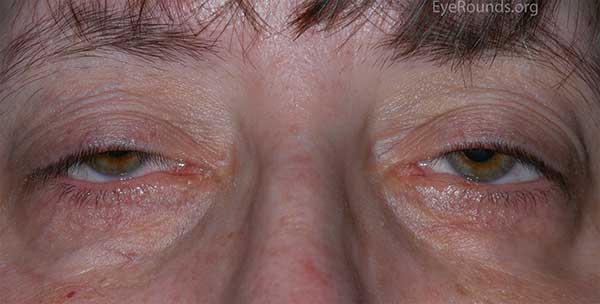 bilateral ptosis in the setting of myotonic dystrophy