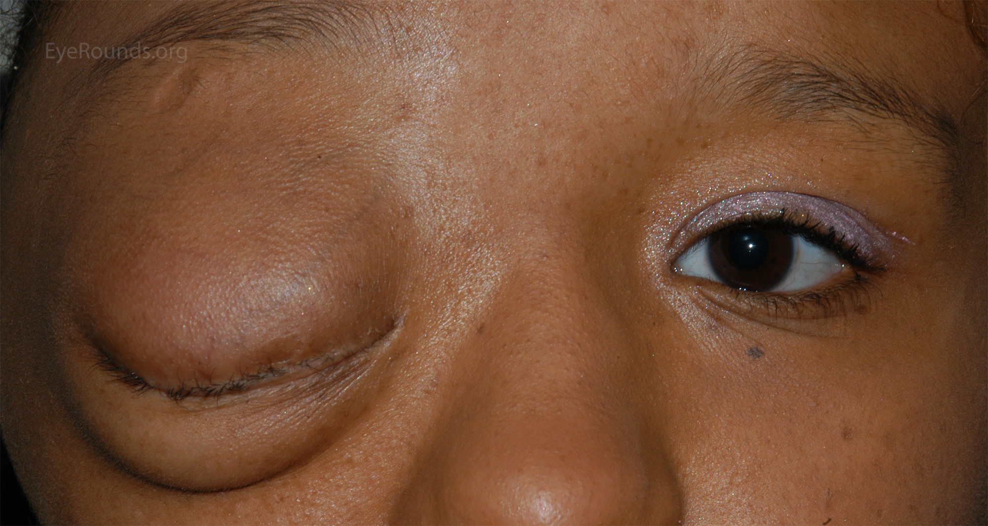 Mechanical ptosis due to a plexiform neurofibroma