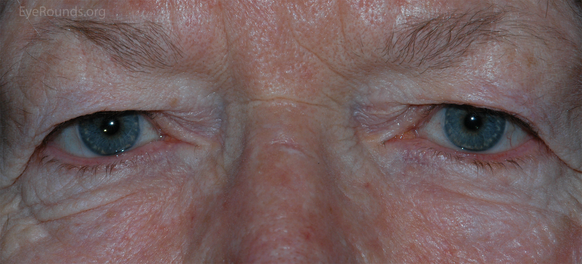 Pseudoptosis due to dermatochalasis