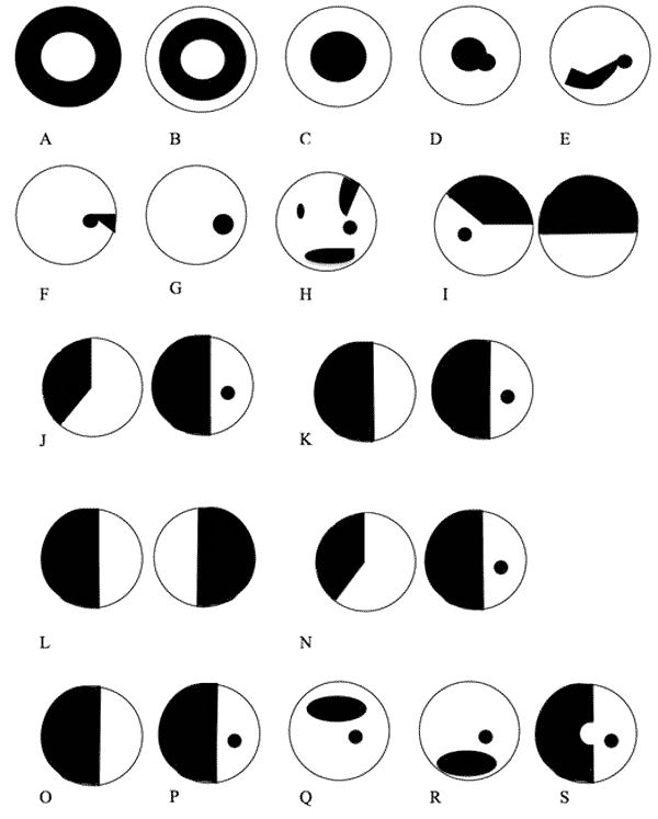 Common visual field defects