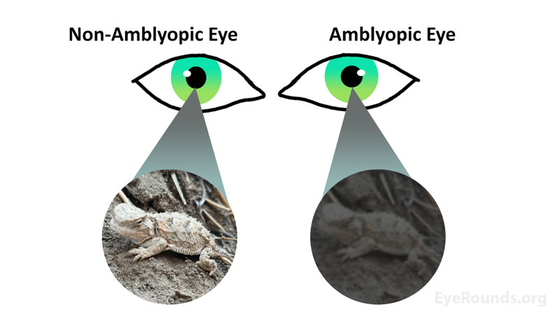 Figure 8 tracing  Amblyopia - An Eye Disorder and Amblyopia Therapy