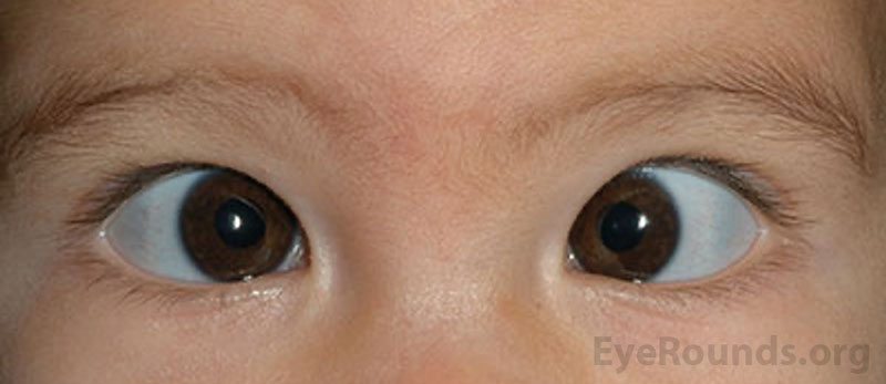 Example of esotropia