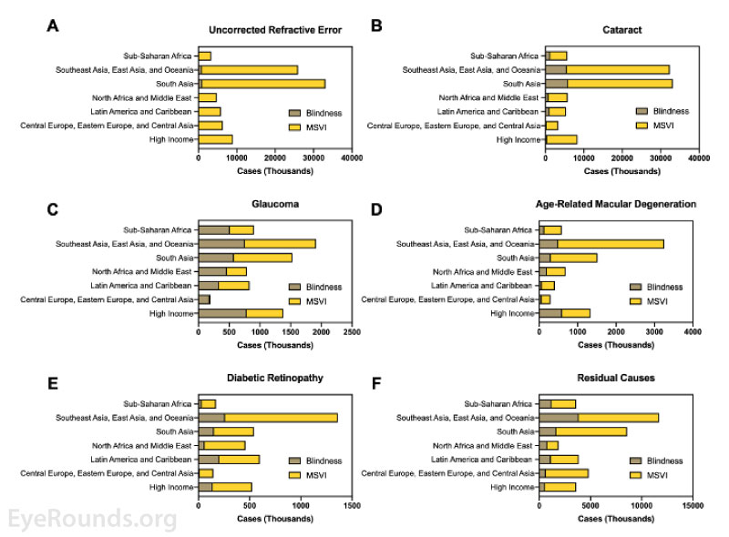 Regional prevalence of blindness and MSVI caused by (A) uncorrected refractive error, (B) cataract, (C) glaucoma, (D) age-related macular degeneration (E) diabetic retinopathy, and (F) residual causes (e.g., trachoma, vitamin A deficiency, etc.).