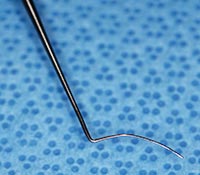 cyclodialysis closeup