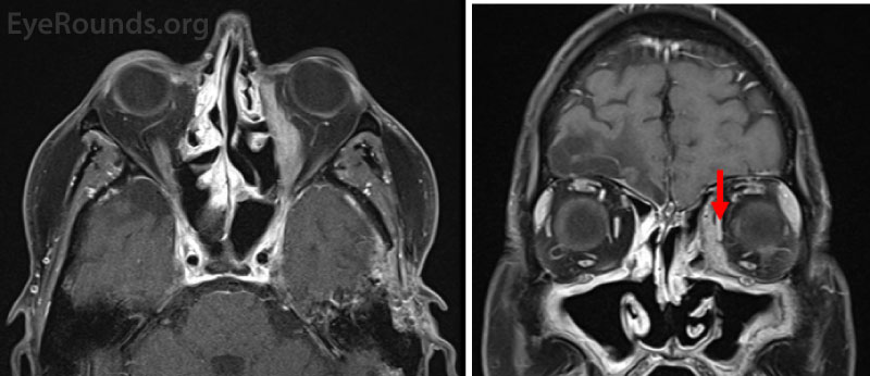 MRI demonstrating a left-sided enhancing orbital mass between the medial rectus and lamina papyracea.