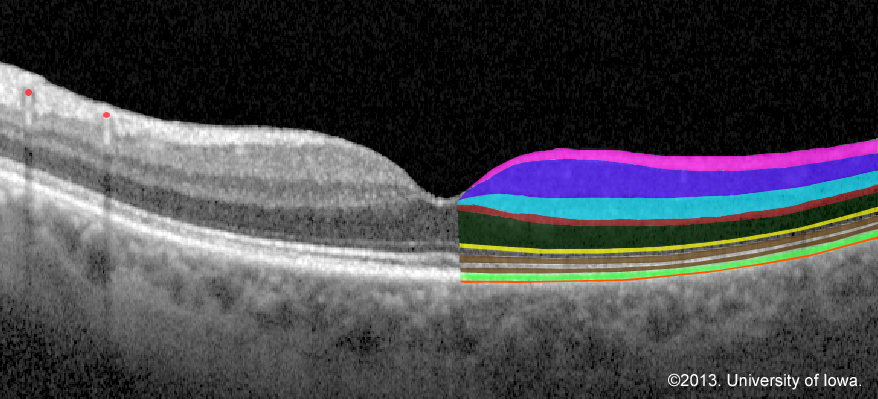 Optical coherence tomography (OCT) image of the retina with the layers colored for clarification 