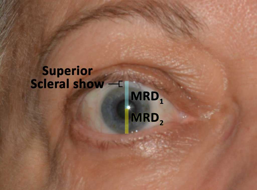 External eye measurements. This patient has lid retraction and superior scleral show. A demonstration of the MRD1 and MRD2 calculations is shown here.