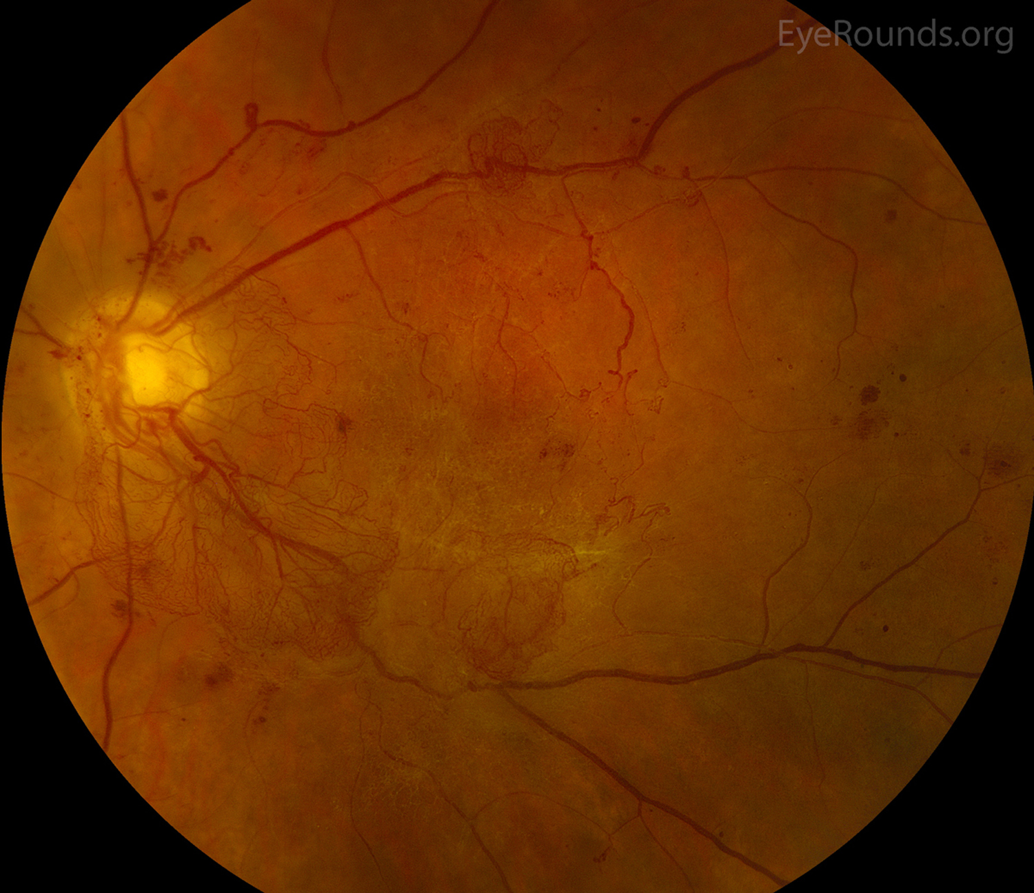 Diabetic retinopathy vitreous hemorrhage